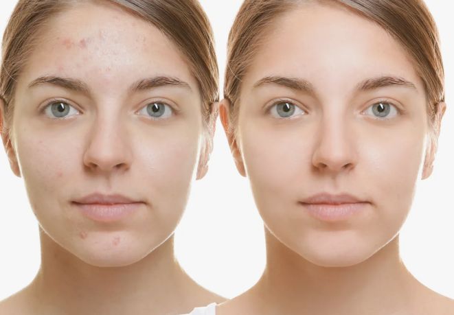 Before &After